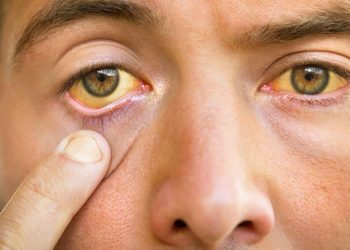 یرقان یا زردی چیست