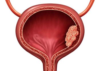 سرطان مثانه