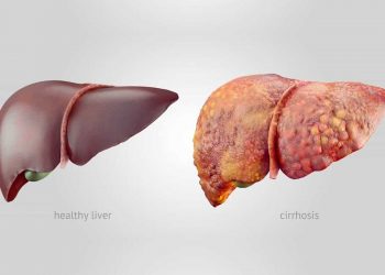 سیروز کبدی