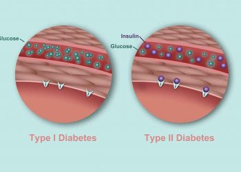 علائم دیابت