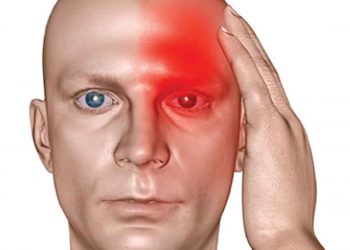 سردرد خوشه ای