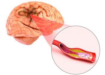 سکته مغزی ایسکمیک