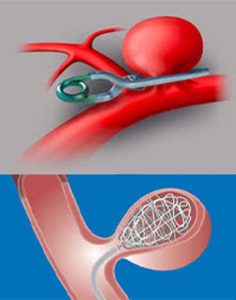 درمان آنوریسم مغزی