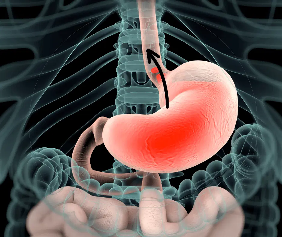 دلایل اصلی رفلاکس معده و درمان خانگی آن