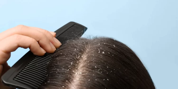 علت های شوره سر و معرفی بهترین روش های خانگی و پزشکی برای درمان شوره سر