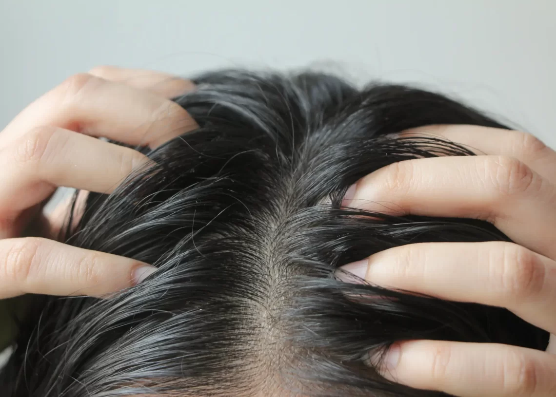 علت های شوره سر و معرفی بهترین روش های خانگی و پزشکی برای درمان شوره سر